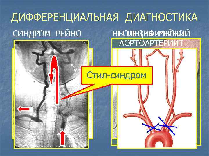 Стил синдром схема