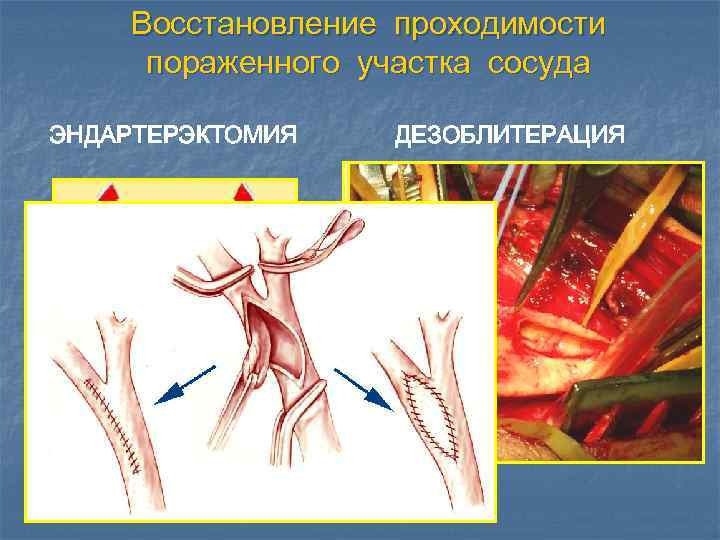 Восстановление проходимости пораженного участка сосуда ЭНДАРТЕРЭКТОМИЯ ДЕЗОБЛИТЕРАЦИЯ 