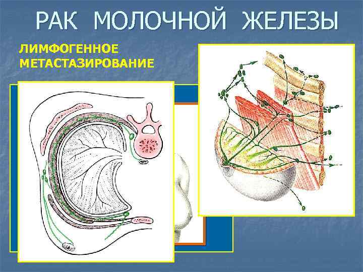 РАК МОЛОЧНОЙ ЖЕЛЕЗЫ ЛИМФОГЕННОЕ МЕТАСТАЗИРОВАНИЕ 