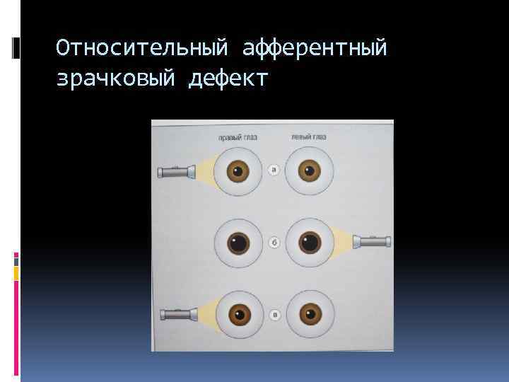 Относительный афферентный зрачковый дефект 