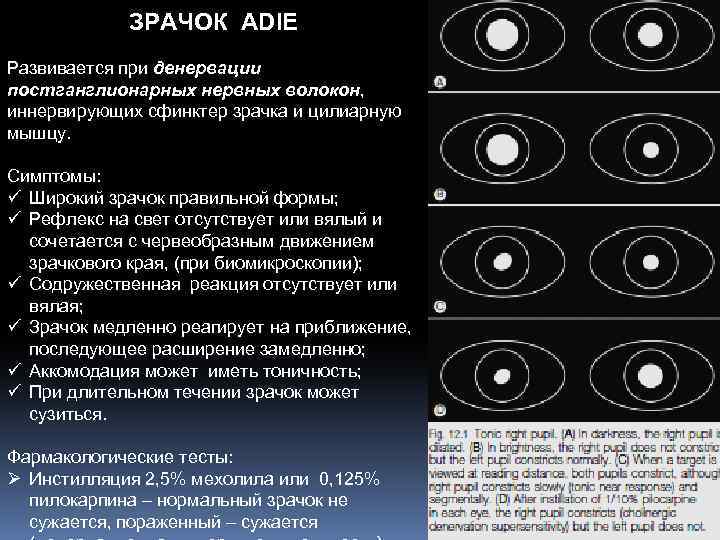 ЗРАЧОК ADIE Развивается при денервации постганглионарных нервных волокон, иннервирующих сфинктер зрачка и цилиарную мышцу.