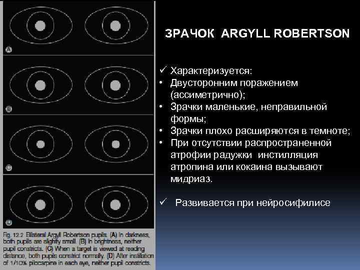 ЗРАЧОК ARGYLL ROBERTSON ü Характеризуется: • Двусторонним поражением (ассиметрично); • Зрачки маленькие, неправильной формы;
