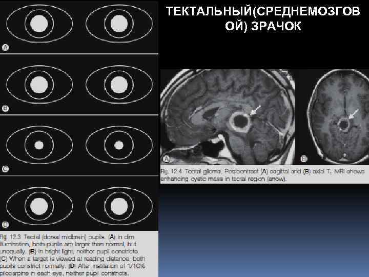 ТЕКТАЛЬНЫЙ(СРЕДНЕМОЗГОВ ОЙ) ЗРАЧОК 