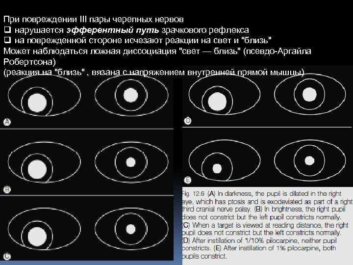 При повреждении III пары черепных нервов q нарушается эфферентный путь зрачкового рефлекса q на