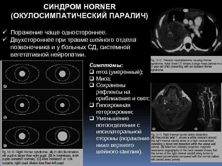 СИНДРОМ HORNER (ОКУЛОСИМПАТИЧЕСКИЙ ПАРАЛИЧ) ü Поражение чаще одностороннее. ü Двухстороннее при травме шейного отдела