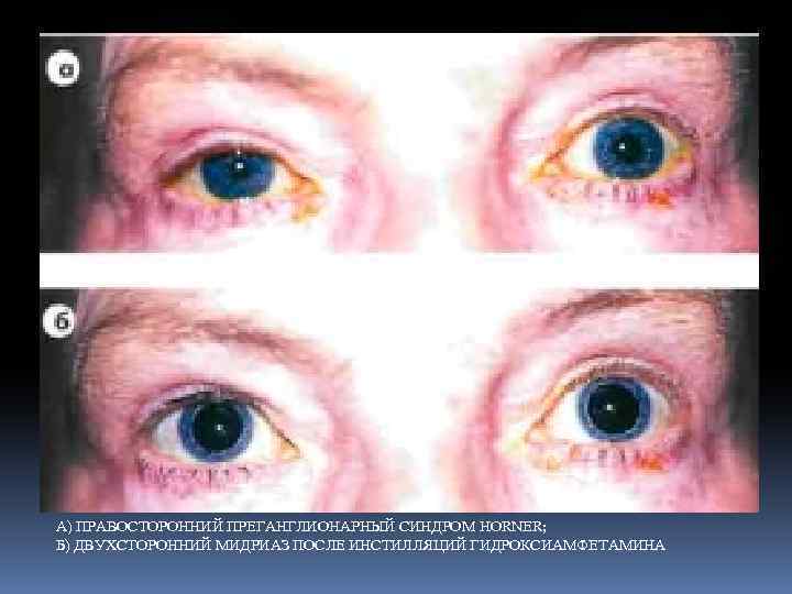 А) ПРАВОСТОРОННИЙ ПРЕГАНГЛИОНАРНЫЙ СИНДРОМ HORNER; Б) ДВУХСТОРОННИЙ МИДРИАЗ ПОСЛЕ ИНСТИЛЛЯЦИЙ ГИДРОКСИАМФЕТАМИНА 