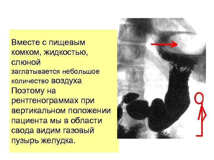 Вместе с пищевым комком, жидкостью, слюной заглатывается небольшое количество воздуха Поэтому на рентгенограммах при