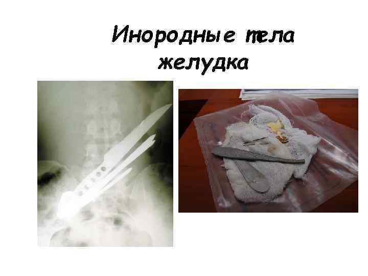 Инородные тела желудка 
