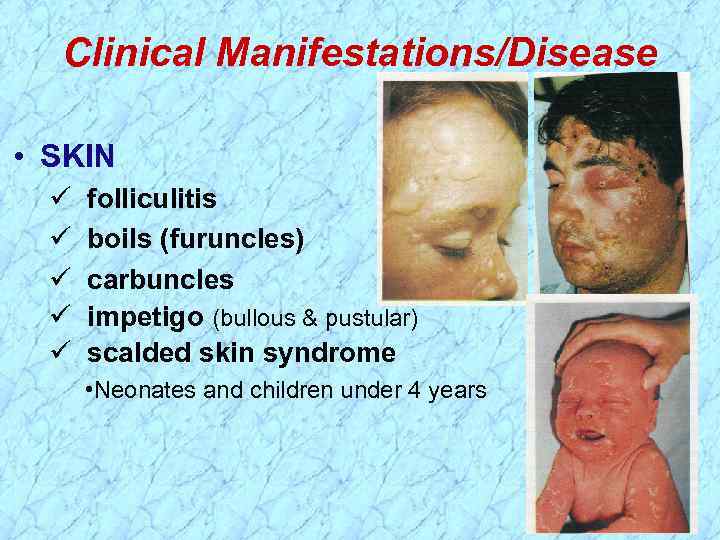 Clinical Manifestations/Disease • SKIN folliculitis boils (furuncles) carbuncles impetigo (bullous & pustular) scalded skin