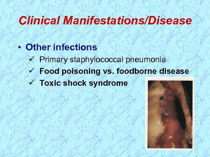 Clinical Manifestations/Disease • Other infections Primary staphylococcal pneumonia Food poisoning vs. foodborne disease Toxic