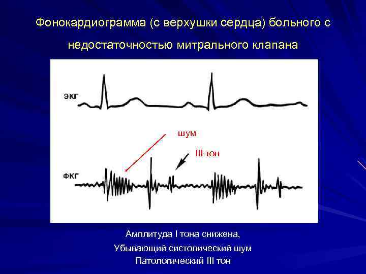 Фонокардиограмма (с верхушки сердца) больного с недостаточностью митрального клапана шум III тон Амплитуда I