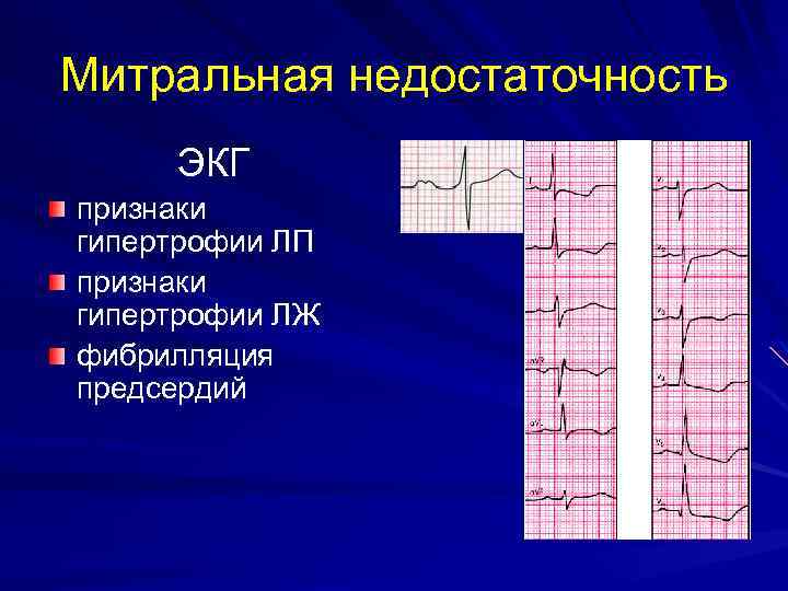 Митральная недостаточность ЭКГ признаки гипертрофии ЛП признаки гипертрофии ЛЖ фибрилляция предсердий 