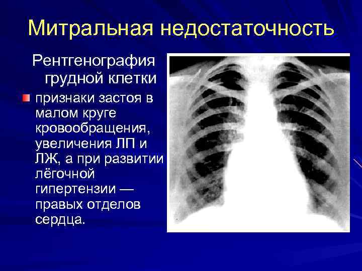 Митральная недостаточность Рентгенография грудной клетки признаки застоя в малом круге кровообращения, увеличения ЛП и