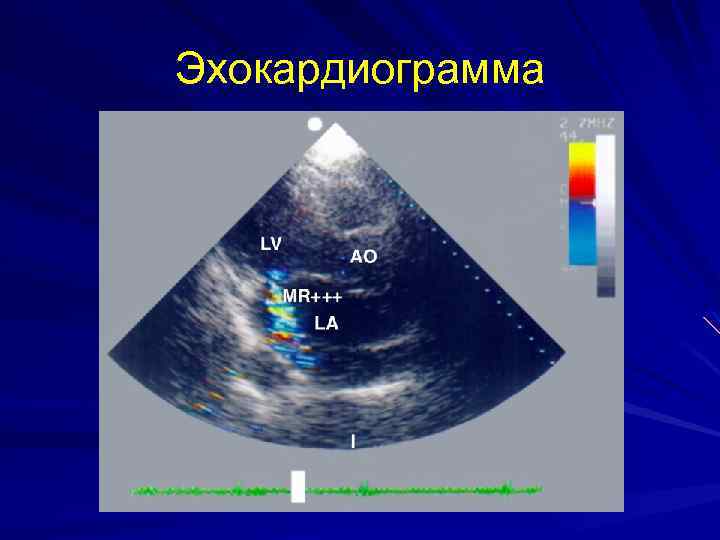 Эхокардиограмма 