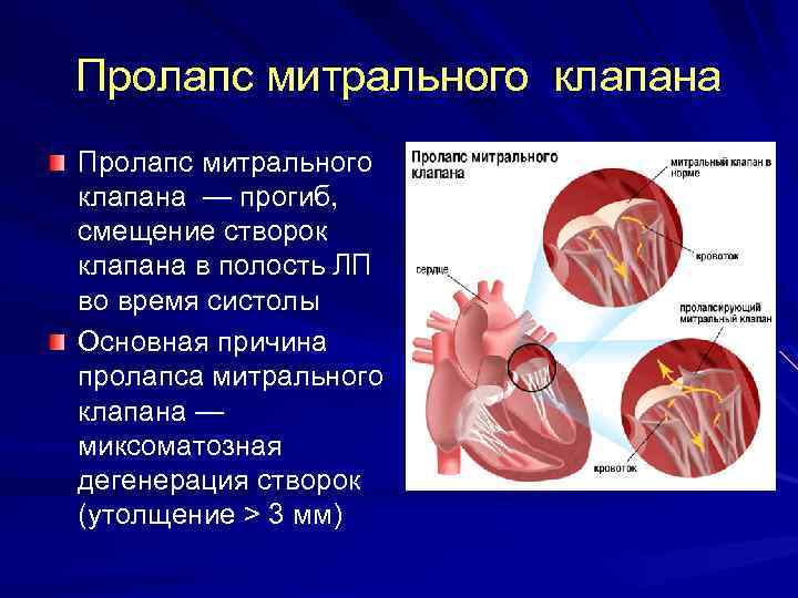 Пролапс митрального клапана — прогиб, смещение створок клапана в полость ЛП во время систолы