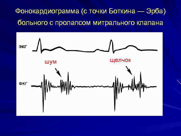 Фонокардиограмма (с точки Боткина — Эрба) больного с пролапсом митрального клапана шум щелчок 