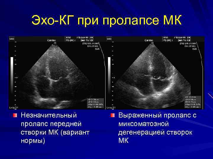 Эхо-КГ при пролапсе МК Незначительный пролапс передней створки МК (вариант нормы) Выраженный пролапс с