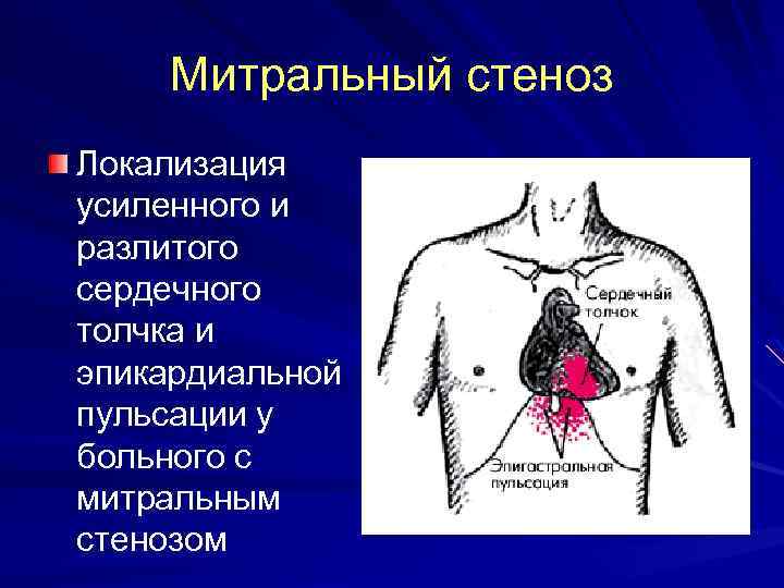 Митральный стеноз Локализация усиленного и разлитого сердечного толчка и эпикардиальной пульсации у больного с