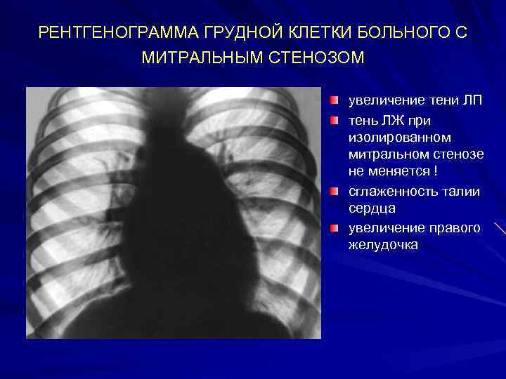 РЕНТГЕНОГРАММА ГРУДНОЙ КЛЕТКИ БОЛЬНОГО С МИТРАЛЬНЫМ СТЕНОЗОМ увеличение тени ЛП тень ЛЖ при изолированном