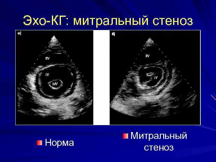 Эхо-КГ: митральный стеноз Норма Митральный стеноз 