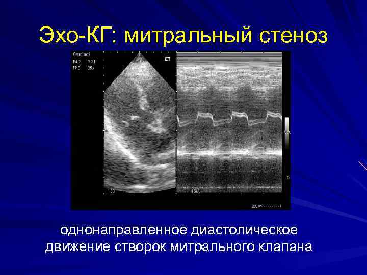 Эхо-КГ: митральный стеноз однонаправленное диастолическое движение створок митрального клапана 