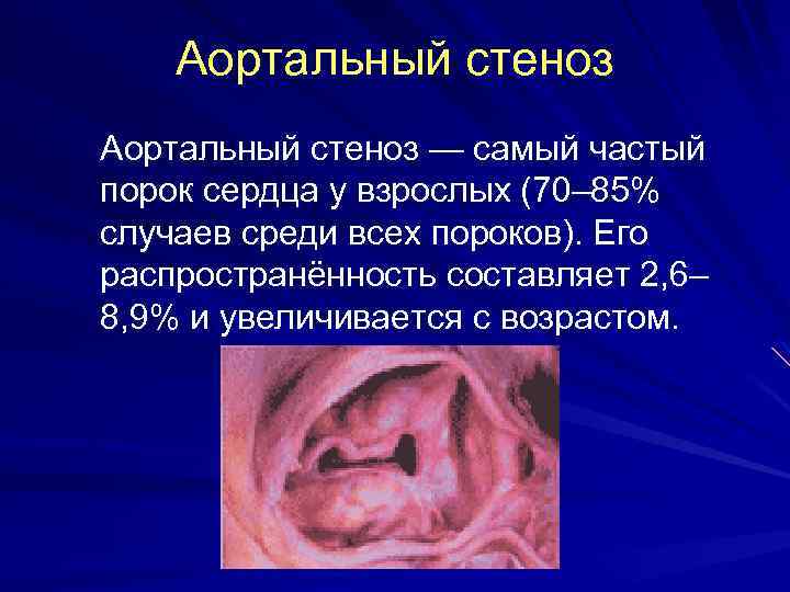 Аортальный стеноз — самый частый порок сердца у взрослых (70– 85% случаев среди всех