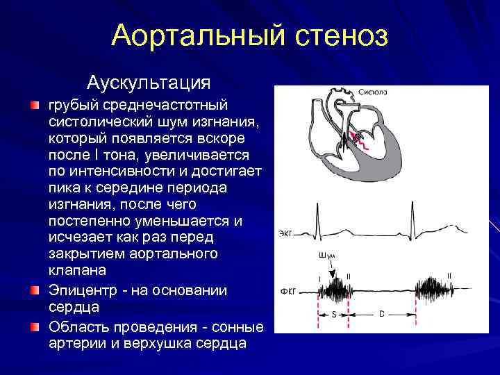 Аортальный стеноз Аускультация грубый среднечастотный систолический шум изгнания, который появляется вскоре после I тона,