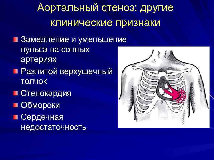 Аортальный стеноз: другие клинические признаки Замедление и уменьшение пульса на сонных артериях Разлитой верхушечный