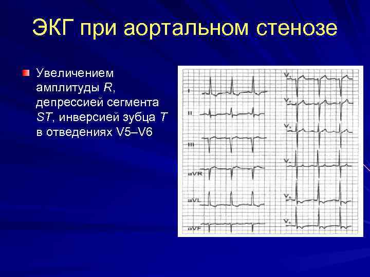 ЭКГ при аортальном стенозе Увеличением амплитуды R, депрессией сегмента ST, инверсией зубца Т в