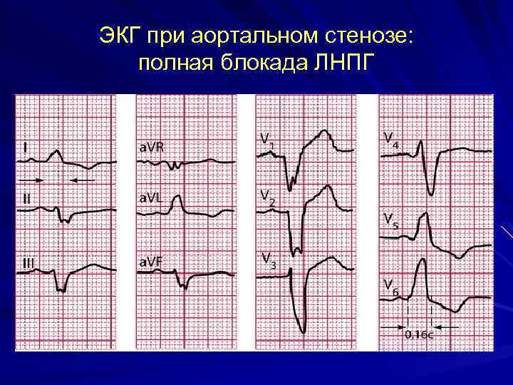 ЭКГ при аортальном стенозе: полная блокада ЛНПГ 