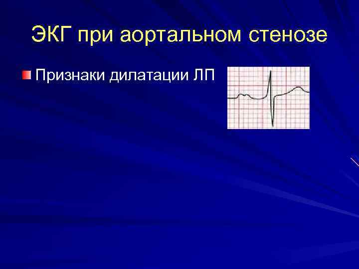 ЭКГ при аортальном стенозе Признаки дилатации ЛП 