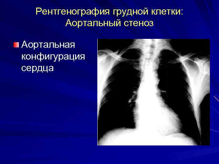 Рентгенография грудной клетки: Аортальный стеноз Аортальная конфигурация сердца 