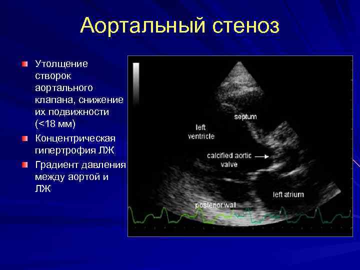 Аортальный стеноз Утолщение створок аортального клапана, снижение их подвижности (<18 мм) Концентрическая гипертрофия ЛЖ