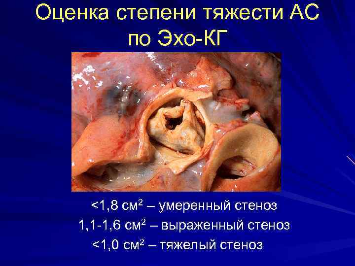 Оценка степени тяжести АС по Эхо-КГ <1, 8 см 2 – умеренный стеноз 1,