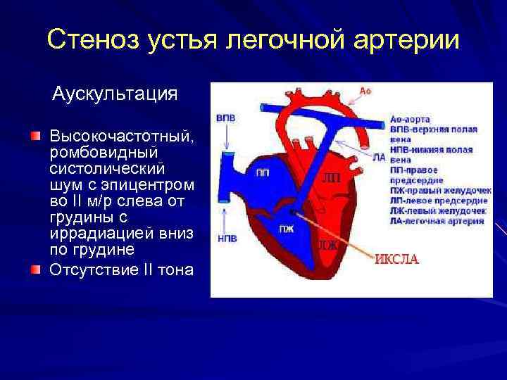 Стеноз устья легочной артерии Аускультация Высокочастотный, ромбовидный систолический шум с эпицентром во II м/р