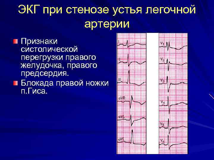 ЭКГ при стенозе устья легочной артерии Признаки систолической перегрузки правого желудочка, правого предсердия. Блокада