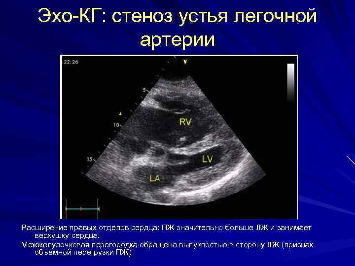 Эхо-КГ: стеноз устья легочной артерии Расширение правых отделов сердца: ПЖ значительно больше ЛЖ и