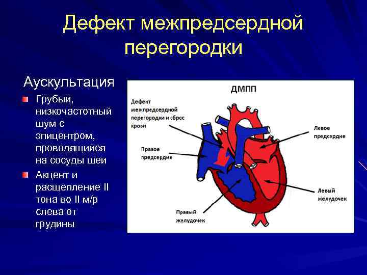 Дефект межпредсердной перегородки Аускультация Грубый, низкочастотный шум с эпицентром, проводящийся на сосуды шеи Акцент