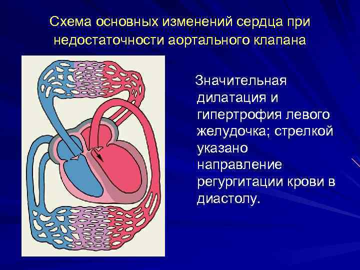 Схема основных изменений сердца при недостаточности аортального клапана Значительная дилатация и гипертрофия левого желудочка;