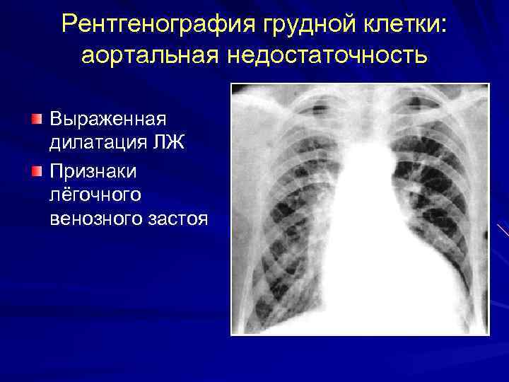 Рентгенография грудной клетки: аортальная недостаточность Выраженная дилатация ЛЖ Признаки лёгочного венозного застоя 