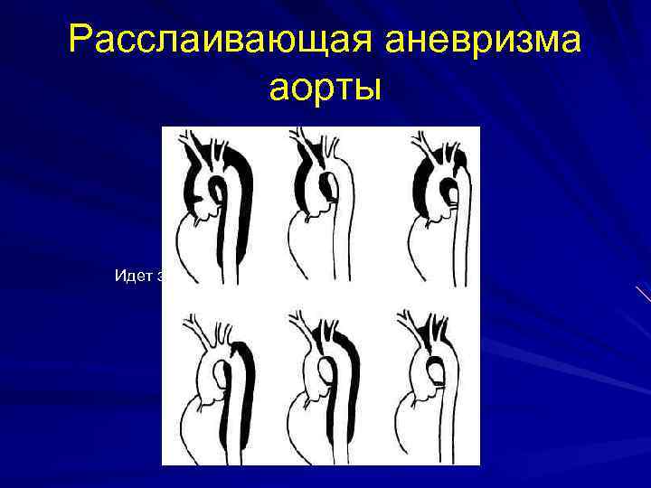 Расслаивающая аневризма аорты Идет загрузка картинки. . . Открыть на сайте 