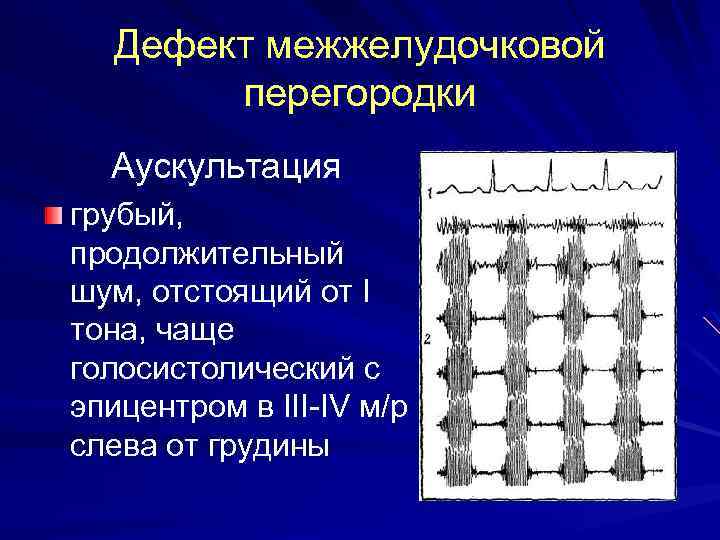 Дефект межжелудочковой перегородки Аускультация грубый, продолжительный шум, отстоящий от I тона, чаще голосистолический с