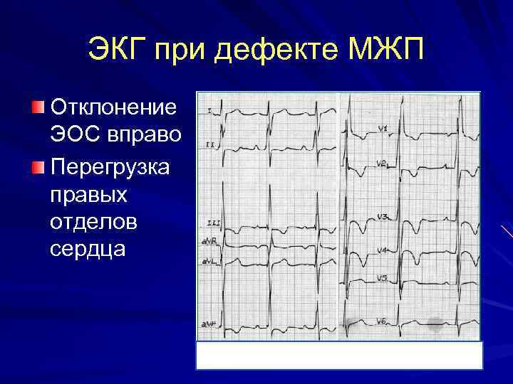 ЭКГ при дефекте МЖП Отклонение ЭОС вправо Перегрузка правых отделов сердца 