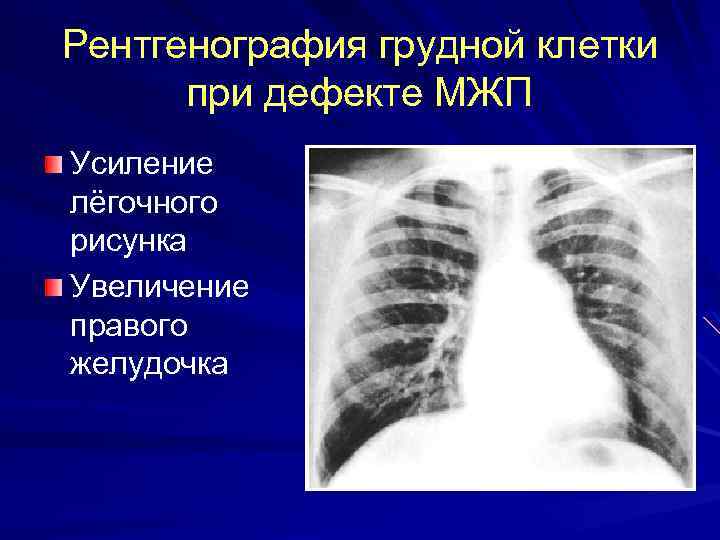 Рентгенография грудной клетки при дефекте МЖП Усиление лёгочного рисунка Увеличение правого желудочка 