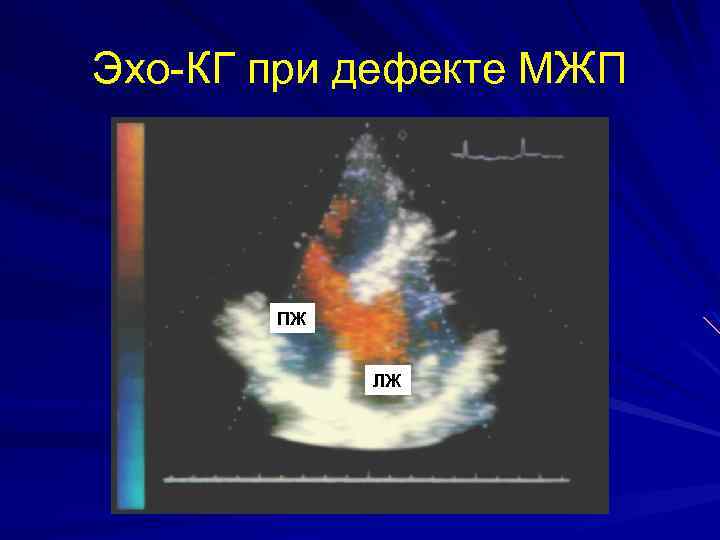 Эхо-КГ при дефекте МЖП ПЖ ЛЖ 