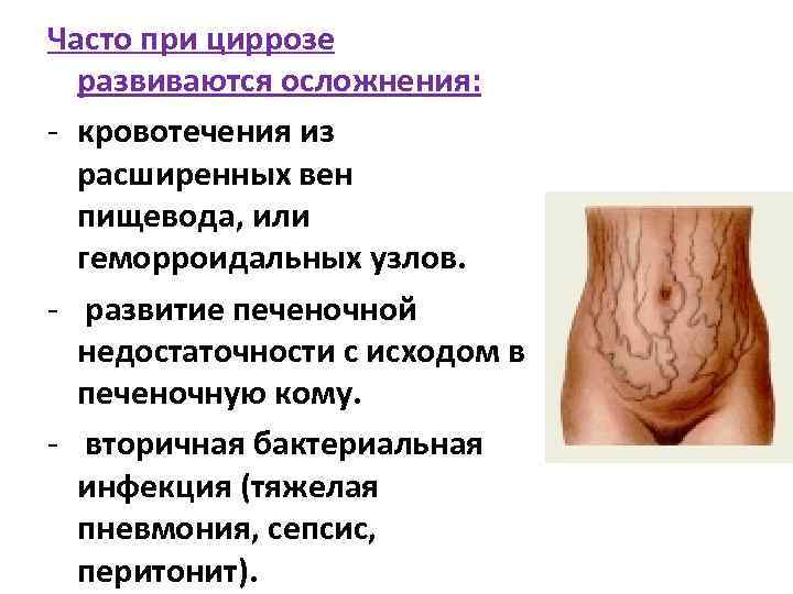 Часто при циррозе развиваются осложнения: - кровотечения из расширенных вен пищевода, или геморроидальных узлов.