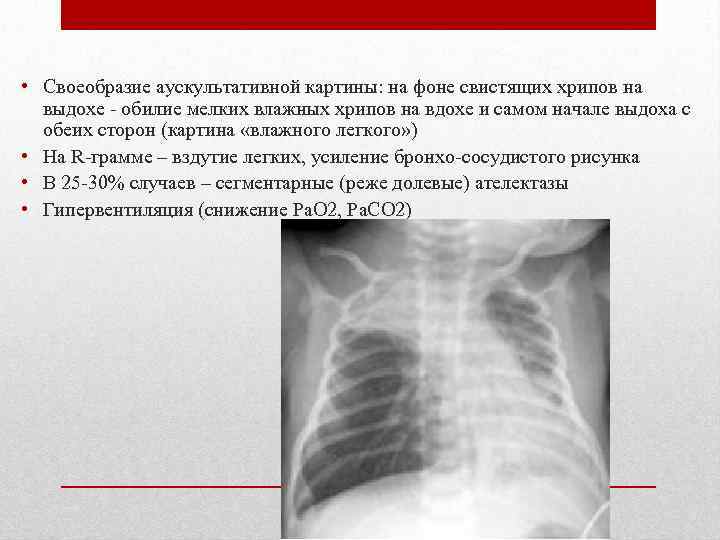  • Своеобразие аускультативной картины: на фоне свистящих хрипов на выдохе - обилие мелких