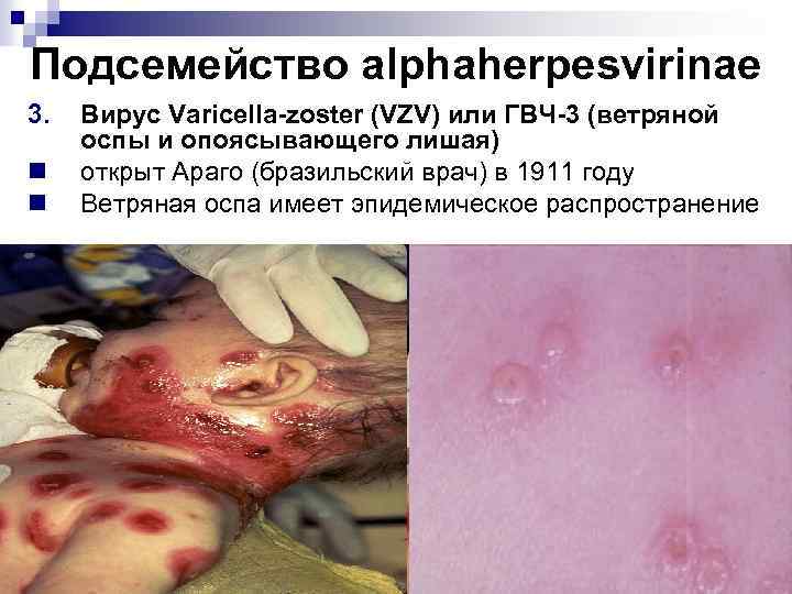 Подсемейство alphaherpesvirinae 3. n n Вирус Varicella-zoster (VZV) или ГВЧ-3 (ветряной оспы и опоясывающего