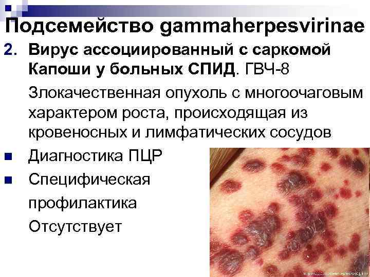 Подсемейство gammaherpesvirinae 2. Вирус ассоциированный с саркомой Капоши у больных СПИД. ГВЧ-8 Злокачественная опухоль