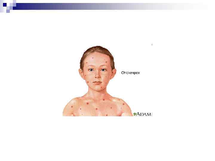 Впг вэб. Вэб инфекция. Репродукция ветряной оспы. Вэб инфекция у детей сыпь.